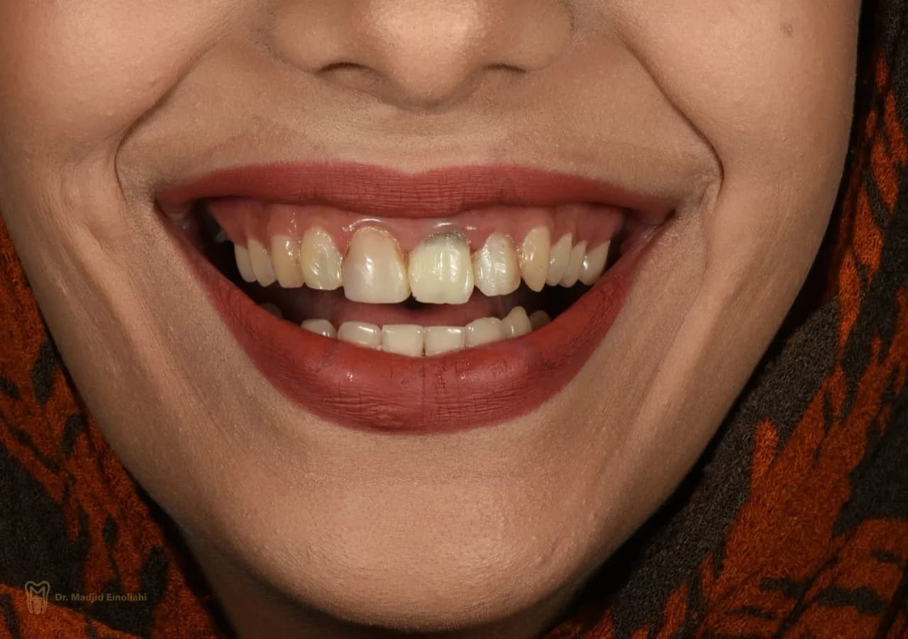 دندان‌های بیمار پیش از طراحی لبخند