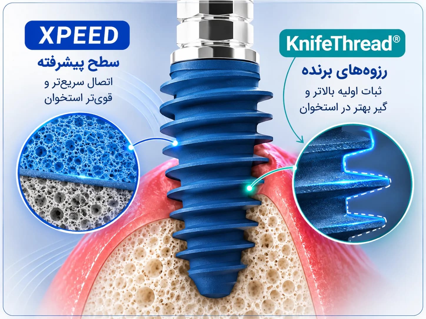 نمودار فناوری سطح XPEED و رزوهٔ KnifeThread ایمپلنت MegaGen AnyOne